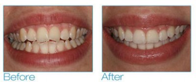 6 month smile before & after